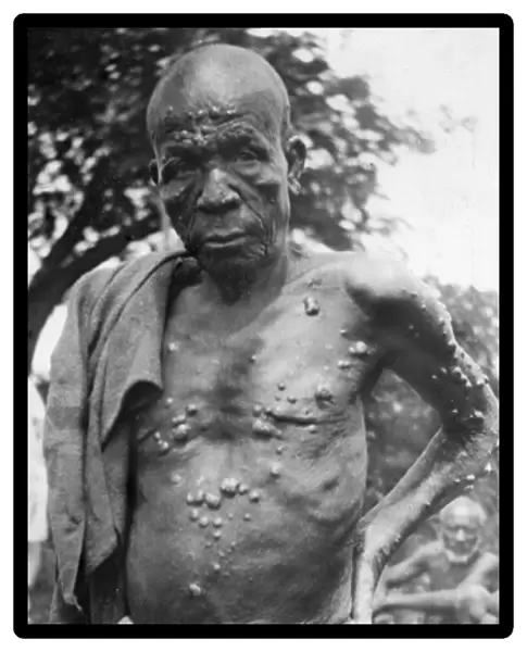Man with leprosy, Mombasa, Kenya, East Africa