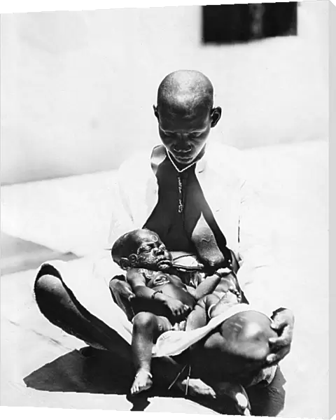 Child with Yaws, Mombasa, Kenya, East Africa