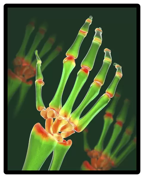 Arthritic hand, X-ray artwork