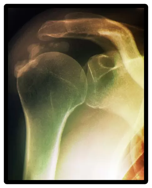 Tendinitis of the shoulder, X-ray