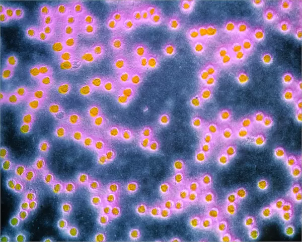 F-colour TEM of papillomavirus from plantar wart