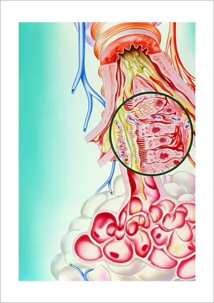 Artwork of the respiratory system of an asthmatic