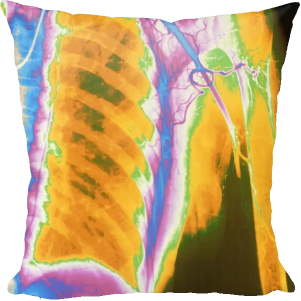 Coloured angiogram of embolus blocking arm artery