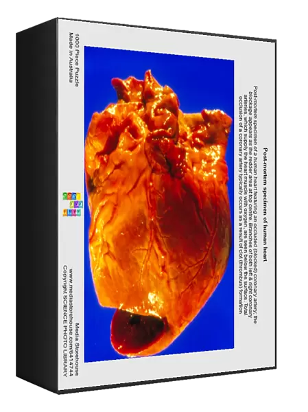 Post-mortem specimen of human heart