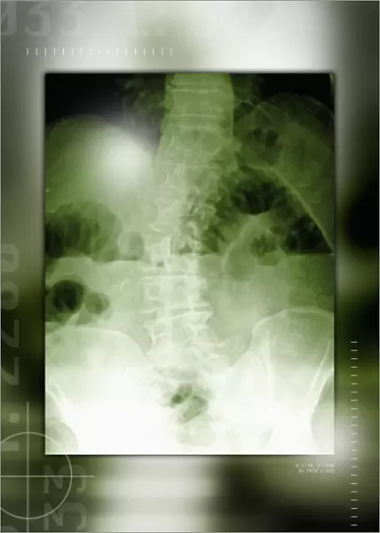 Gases in the abdomen, X-ray