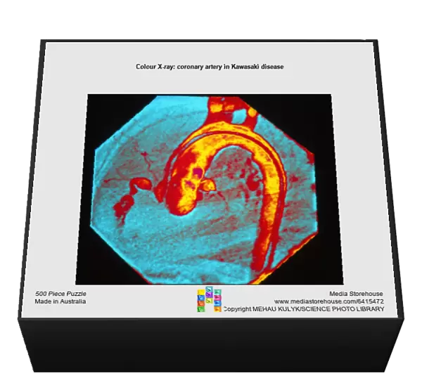 Colour X-ray: coronary artery in Kawasaki disease