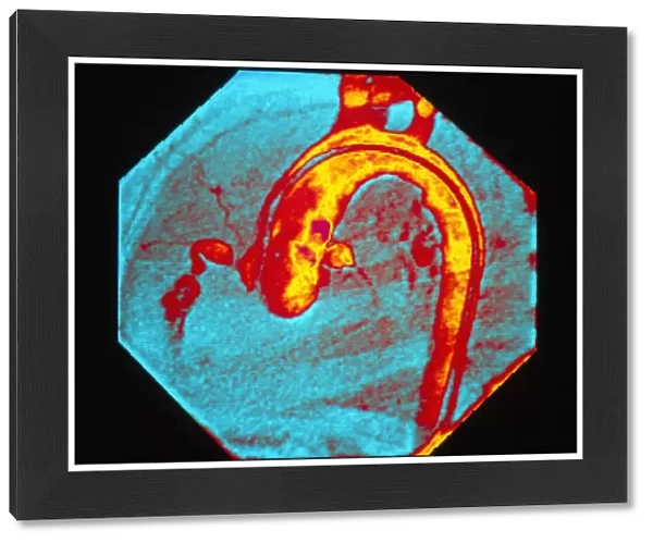 Colour X-ray: coronary artery in Kawasaki disease