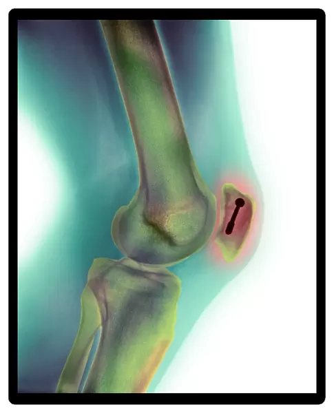 Pinned kneecap fracture, X-ray