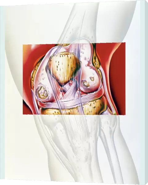 Artwork showing rheumatoid arthritis of the knee