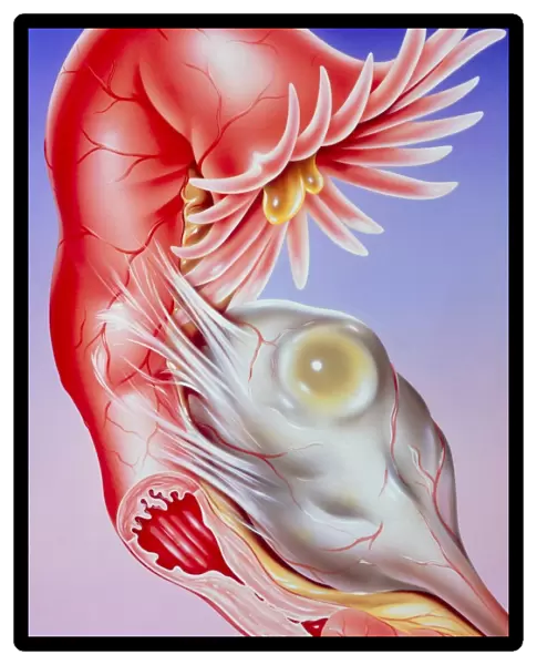 Illustration of fallopian tube infertility