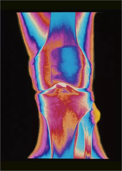 Coloured X-ray of a human knee joint (front view)