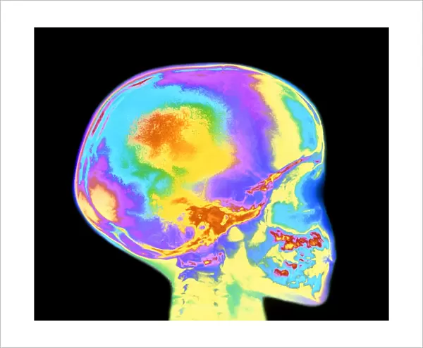 Coloured X-ray of childs skull and tooth eruption