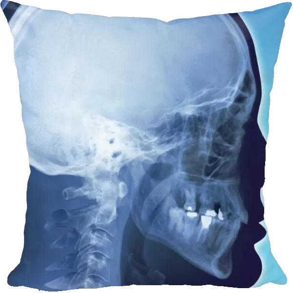 Healthy skull, coloured X-ray