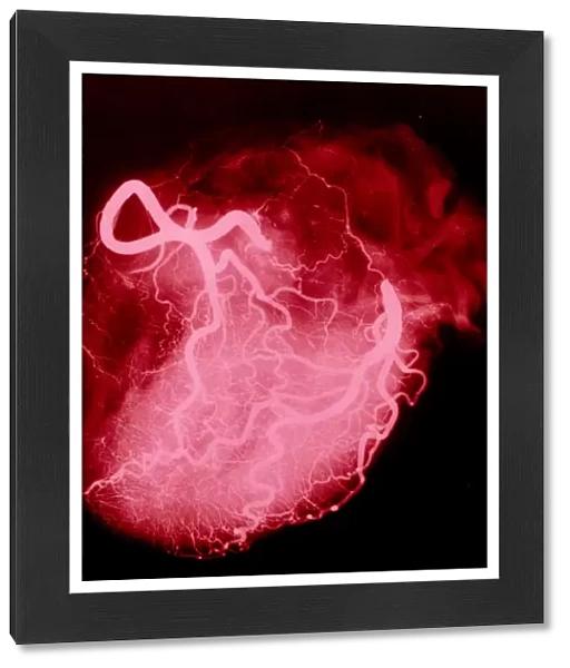 Arteriograph of the coronary arteries of the heart