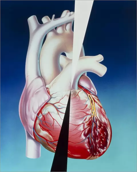 Artwork of heart attack due to atherosclerosis