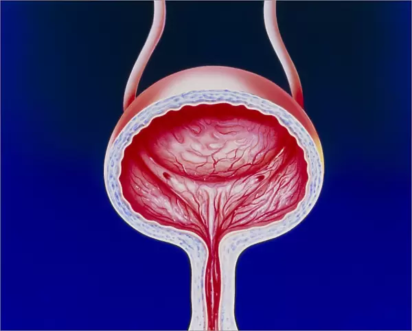 Illustration of a female bladder with cystitis
