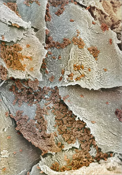Bacterial infection of nail, SEM