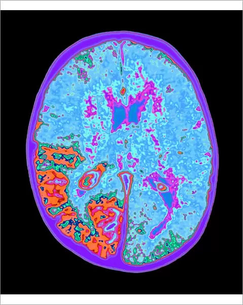Coloured MRI brain scan of Sturge-Weber syndrome
