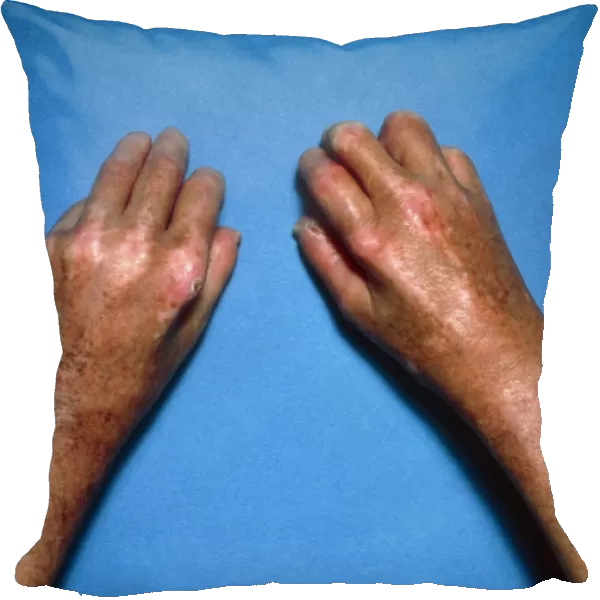 Shiny toughened skin on hands due to scleroderma