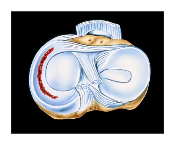 Artwork of torn knee cartilage in sports injury
