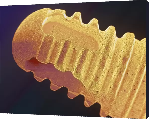Coloured SEM of the root of a dental implant