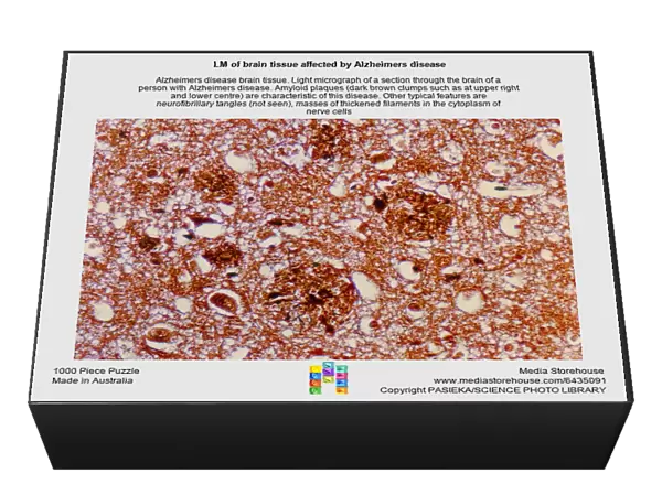 LM of brain tissue affected by Alzheimers disease