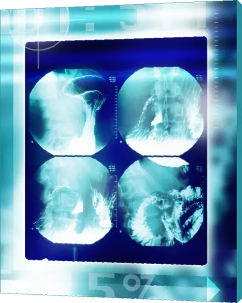 Small intestine, barium X-ray