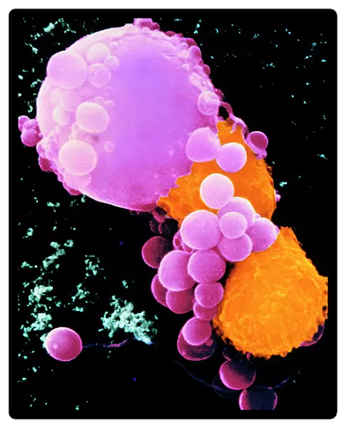 Coloured SEM of lymphocytes attacking cancer cell