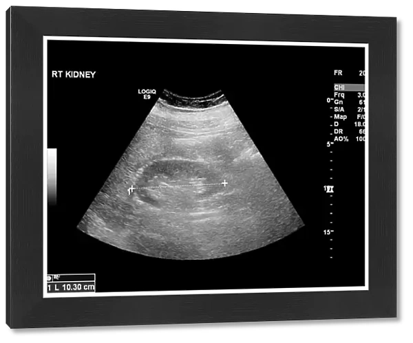 Liver mass, ultrasound scan C017  /  7780