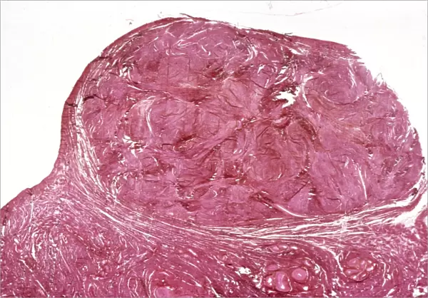 Uterine fibroid, light micrograph C015  /  6412