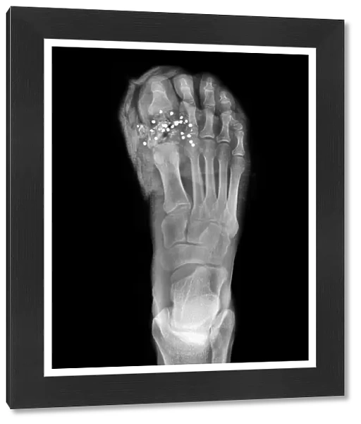 Firearm injury, X-ray C017  /  7873