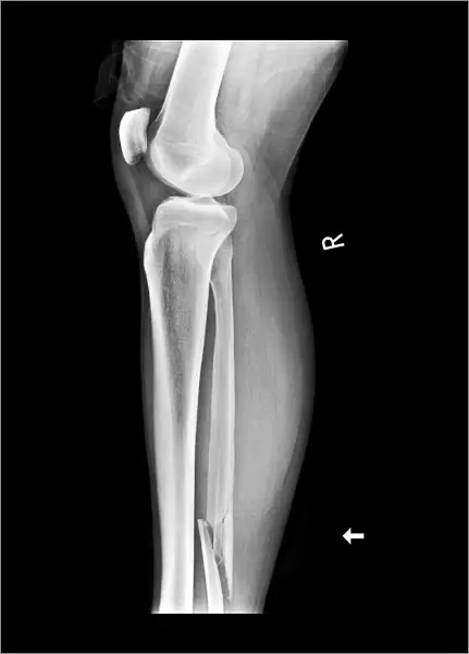 Broken leg, X-ray C017  /  7977