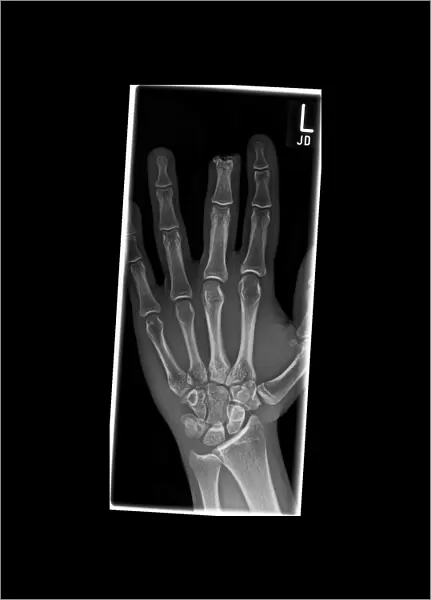 Amputated finger, X-ray C017  /  8010