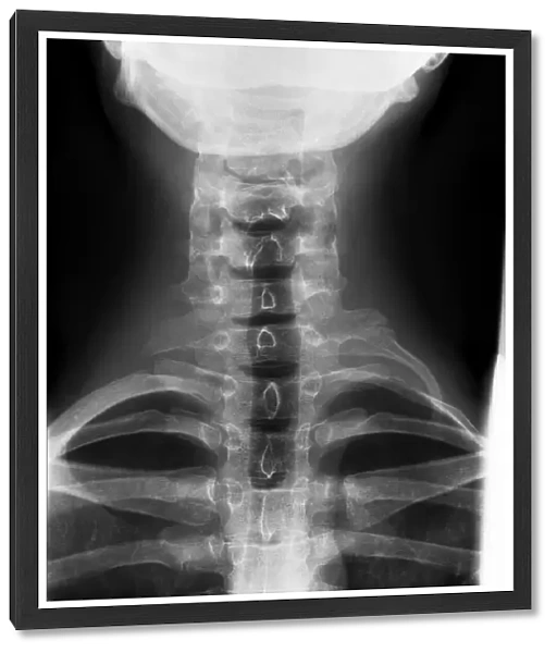 Cervical rib, X-ray C017  /  8024