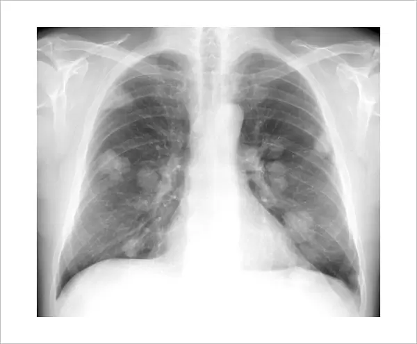 Secondary lung cancers, X-ray