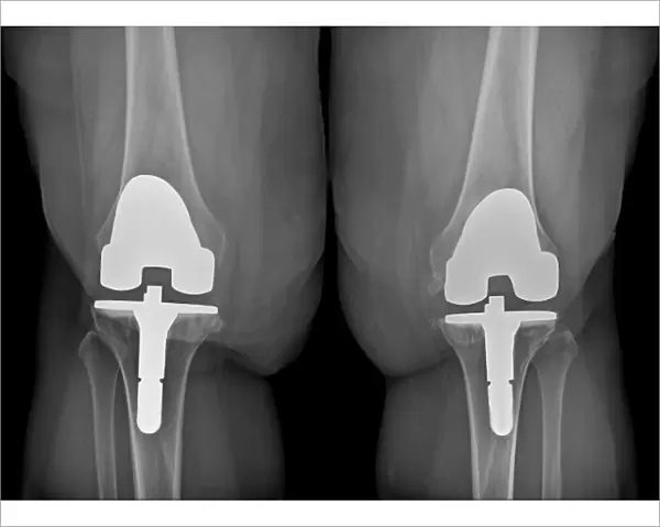 Prosthetic knees and obesity, X-ray C016  /  6596