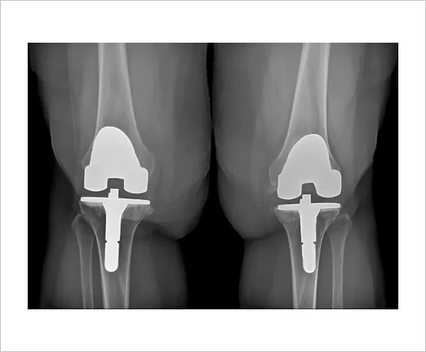 Prosthetic knees and obesity, X-ray C016  /  6596