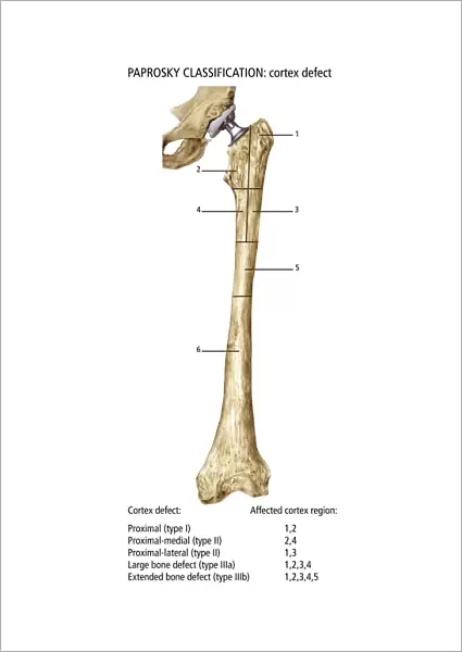 Paprosky femur defect classification C016  /  6621