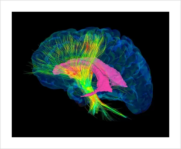 Brain fibres, DTI MRI scan C017  /  7036