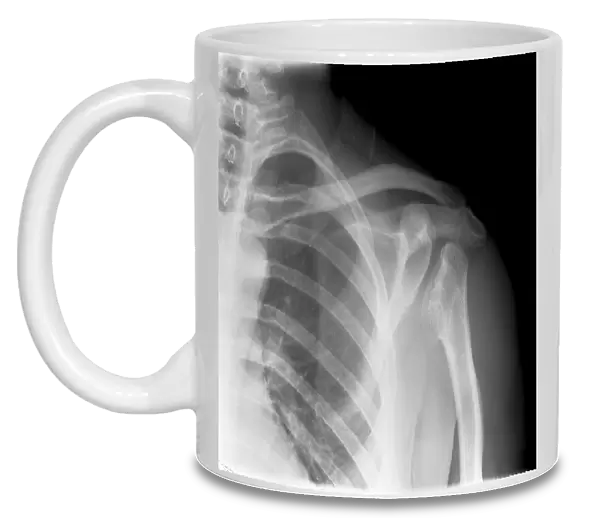 Septic arthritis, X-ray C017  /  7385