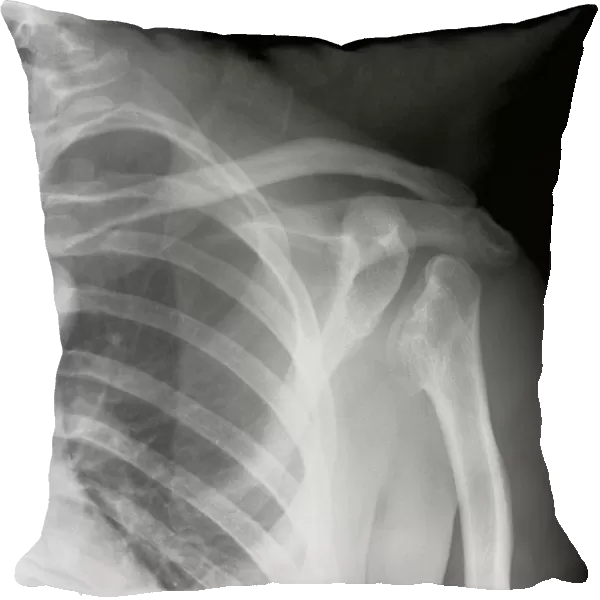 Septic arthritis, X-ray C017  /  7385
