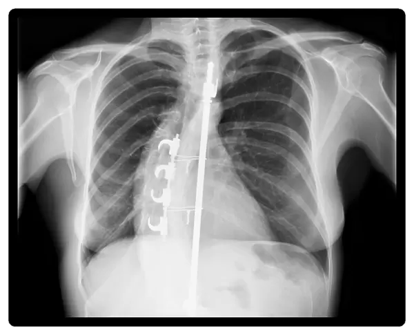 Scoliosis treatment, X-ray C017  /  7156