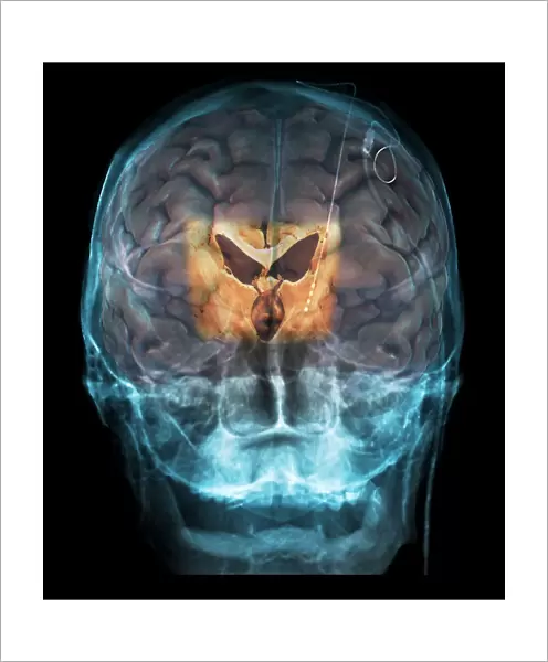 Brain implants for Parkinsons disease