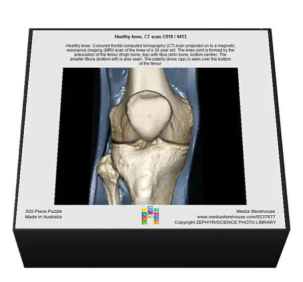 Healthy knee, CT scan C018  /  0413