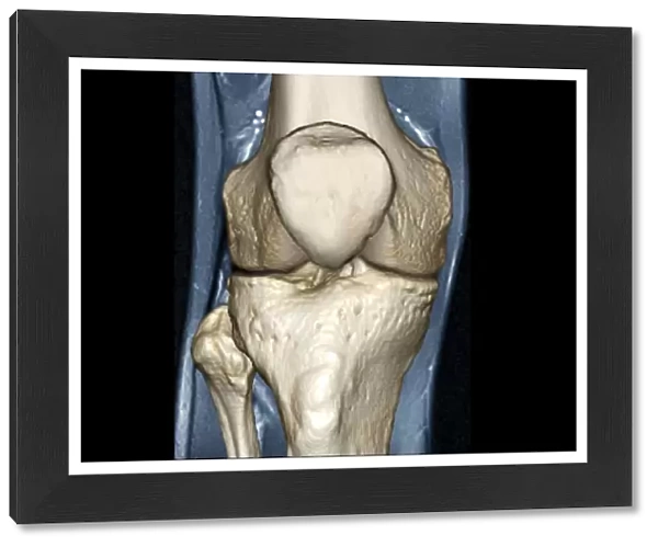 Healthy knee, CT scan C018  /  0413