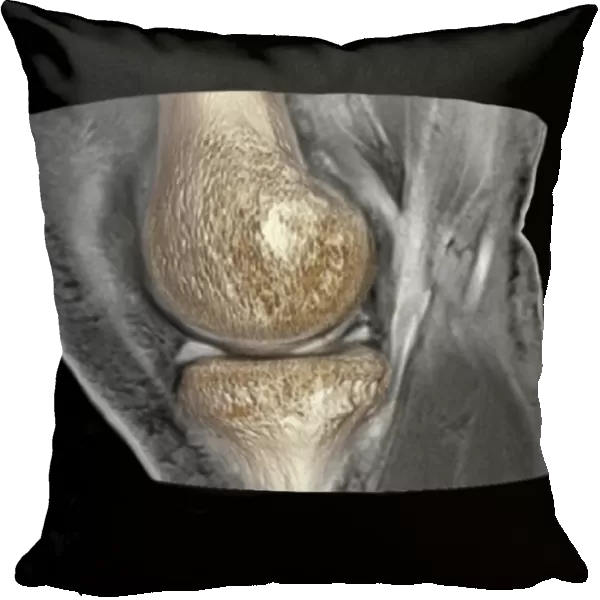 Knee injury, 3D CT scan C018  /  0648