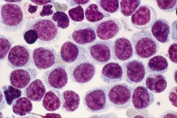 Hairy cell leukaemia, light micrograph