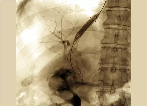 Portal vein surgery, X-ray C016  /  6545