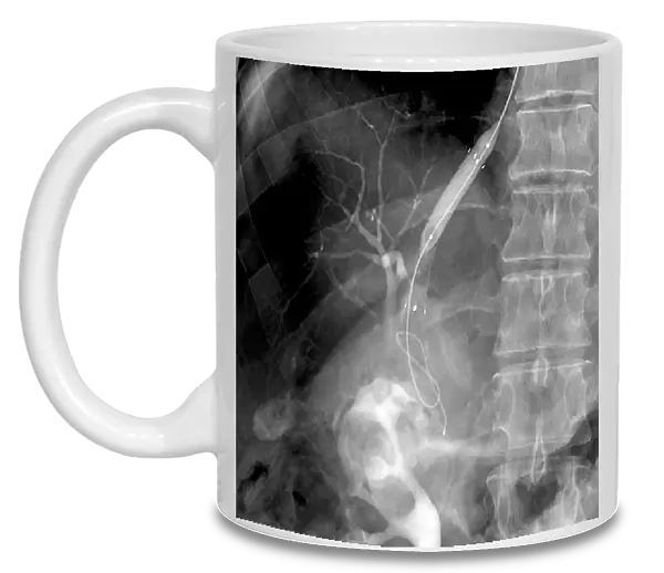 Portal vein surgery, X-ray C016  /  6543