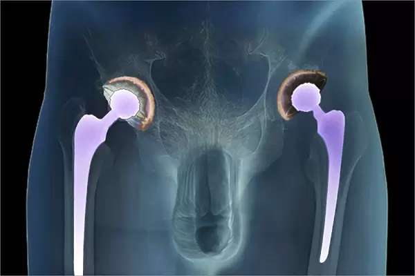Double hip replacement, X-ray C016  /  6446